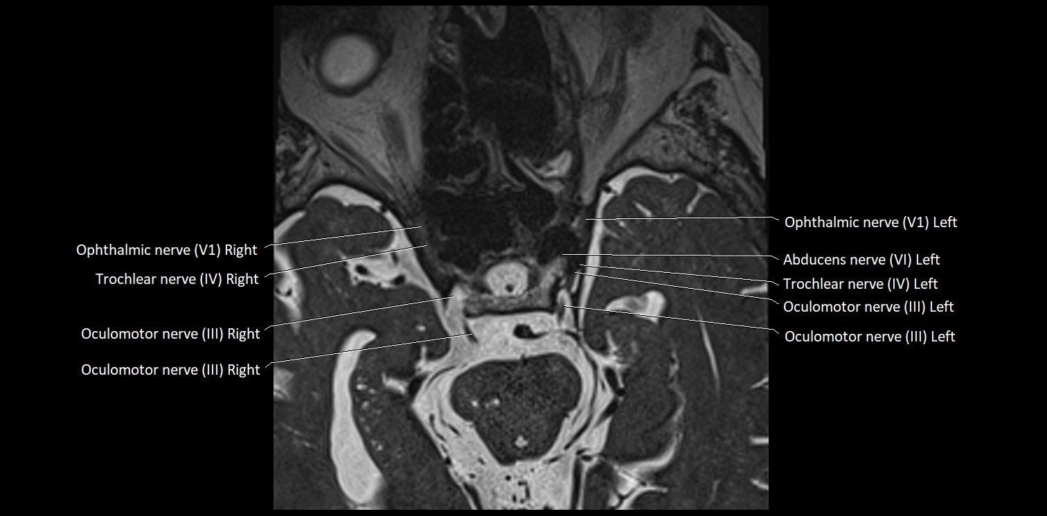 Cranial nerve anatomy axial MRI 3T image 24.webp
